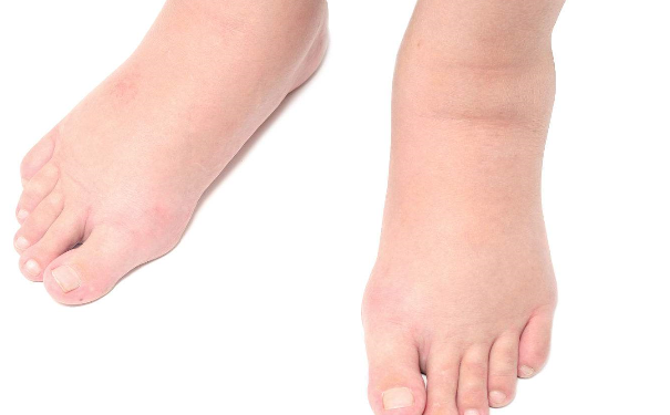 how to quickly eliminate edema?